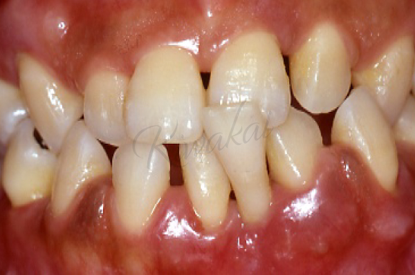 重度歯周病に対して、再生治療と矯正治療を併用し、被せ物の治療を行った症例
