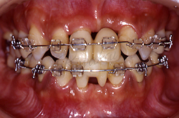 重度歯周病に対して、再生治療と矯正治療を併用し、被せ物の治療を行った症例