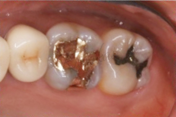 奥歯にセラミックアンレー修復とコンポジットレジン修復