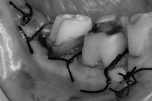 歯周外科処置