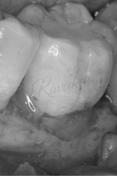歯周組織再生療法（エムドゲイン）