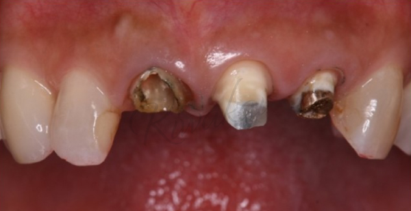 歯周外科処置、ジルコニアセラミック修復とコンポジットレジン修復