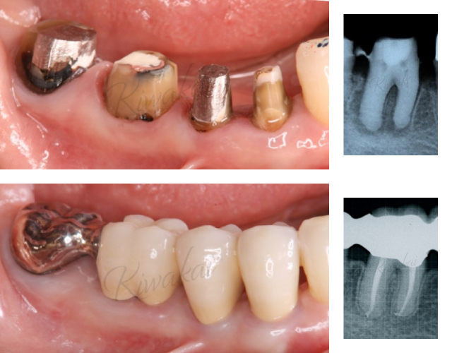 根管治療、歯周外科処置、メタルセラミッククラウン修復